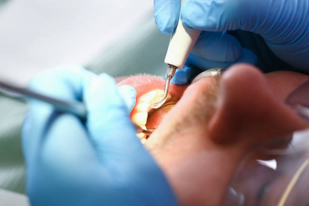 Best Knocked-Out Tooth (Avulsed Tooth) Treatment in Myrtle Grove, NC