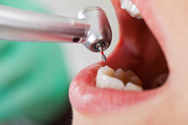Best Knocked-Out Tooth (Avulsed Tooth) Treatment in Myrtle Grove, NC